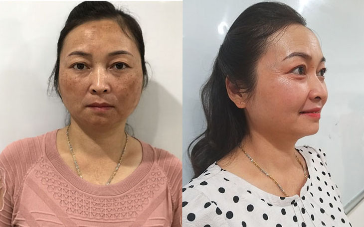 Làn da của cô Vân trước và sau khi điều trị với Liệu trình Vương Phi