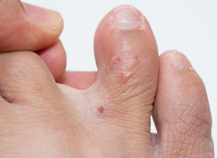 Bệnh tổ đỉa ở chân là bệnh lý viêm da thường gặp nhất