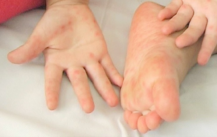 Có rất nhiều nguyên nhân gây ra bệnh lý tổ đỉa ở chân