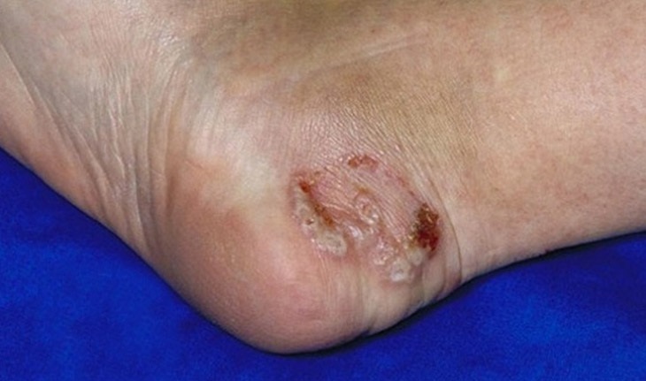 Hắc lào ở chân là bệnh lý về da phổ biến hiện nay