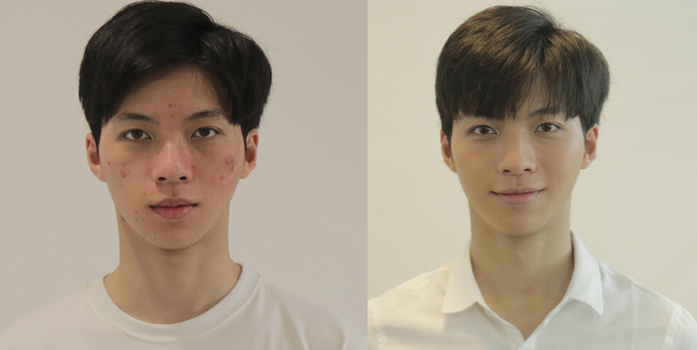 Hình ảnh trước và sau khi điều trị mụn bằng Nhất Nam Hoàn Nguyên Bì của Trọng Hiếu