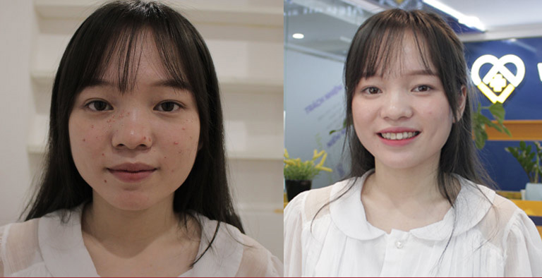 Hình ảnh trước và sau khi dùng Nhất Nam Hoàn Nguyên Bì của Nhật Linh