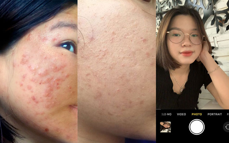Làn da của Lý Mỹ trước và sau khi điều trị mụn tại Trung tâm Da liễu Đông y Việt Nam