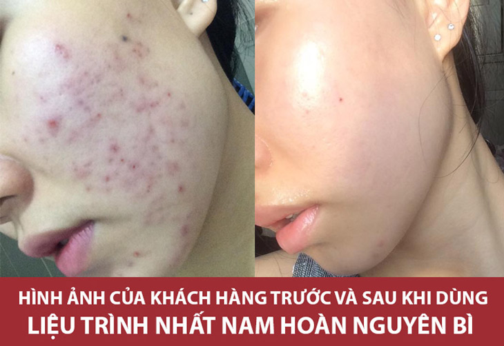 Làn da của khách hàng Hoàng Thị Uyên sau khi điều trị với Nhất Nam Hoàn Nguyên Bì