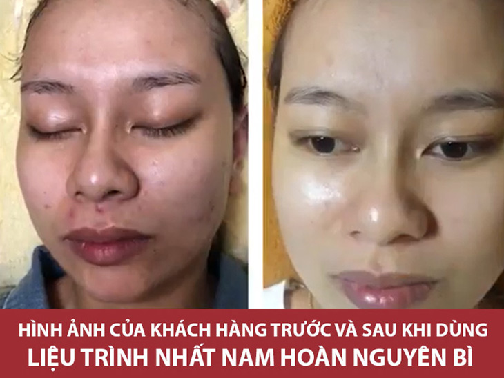 Làn da của khách hàng Thái Nữ Thủy Ngân sau khi điều trị mụn với liệu trình thảo dược Nhất Nam Hoàn Nguyên Bì