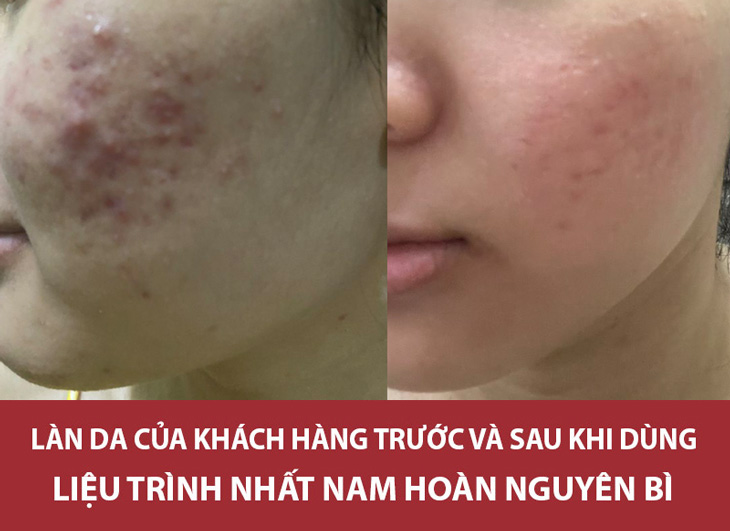 Làn da của khách hàng Hoài Phương đã phục hồi khá tốt sau 3 tháng dùng Nhất Nam Hoàn Nguyên Bì