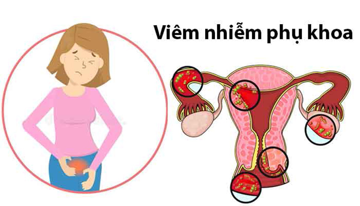 Viêm phụ khoa hình thành ở nhiều khu vực trên hệ thống sinh dục nữ