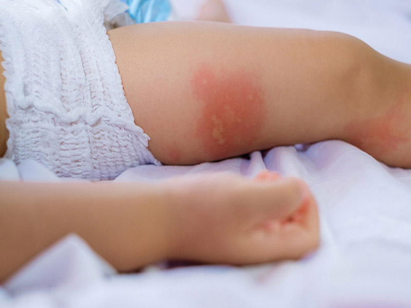 Trẻ em là đối tượng dễ mắc viêm da tiếp xúc