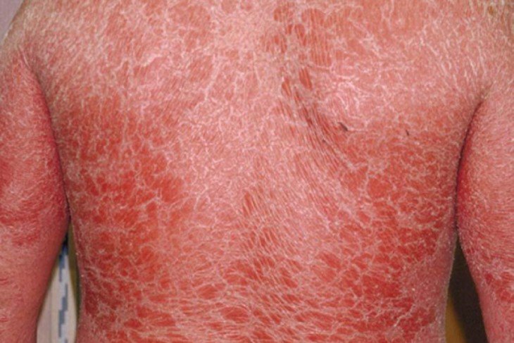 Đỏ da toàn thân là biến chứng của bệnh viêm da dầu