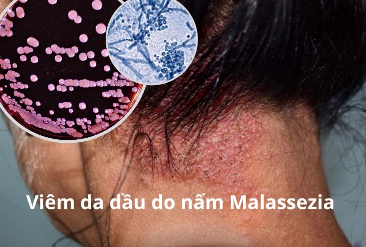 Nấm Malassezia là nguyên nhân chính gây bệnh viêm da dầu