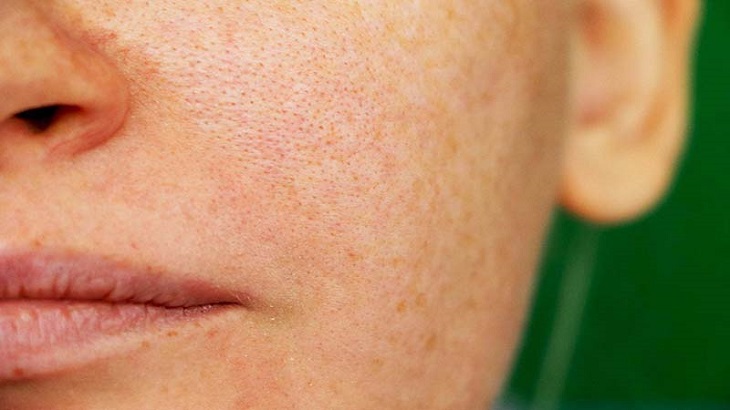 Viêm nang lông ở mặt tức là tình trạng lỗ chân lông bị viêm ở vùng mặt
