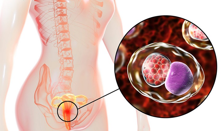 Máu kinh có màu đen có thể là dấu hiệu cảnh báo viêm nội mạc tử cung