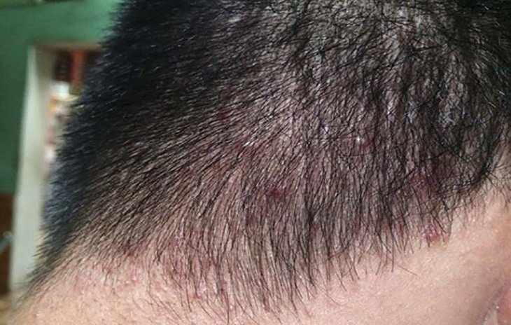Hình ảnh viêm nang lông da đầu