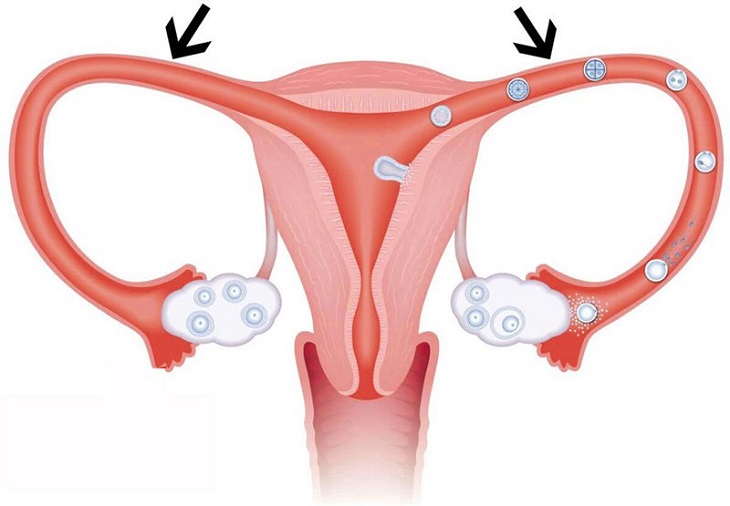 Có rất nhiều nguyên nhân gây tắc hẹp vòi trứng ở nữ giới