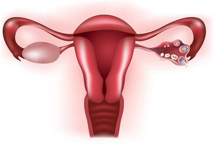 Nữ giới bị tắc vòi trứng có làm IVF được không? Câu trả lời là có