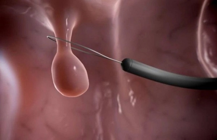 Thủ thuật xoắn polyp cổ tử cung là phương pháp điều trị polyp phổ biến