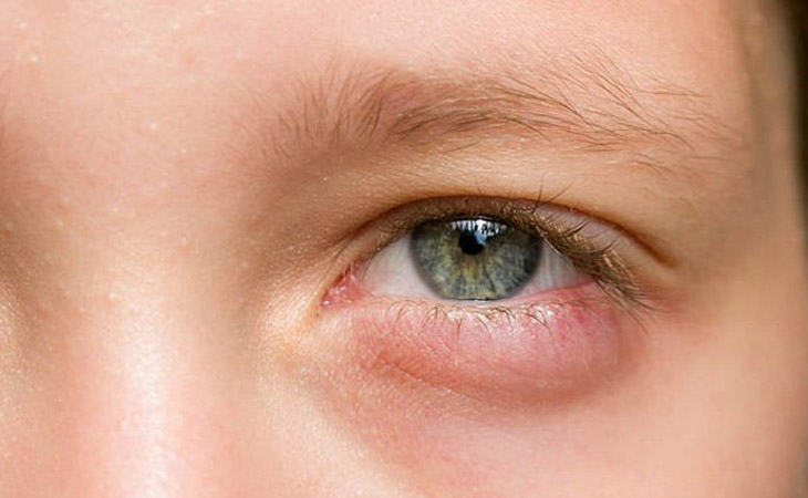 Bệnh có thể gây sưng phù, nhiễm khuẩn mắt