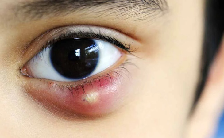 Tác động lên huyệt vị giúp điều trị lẹo mắt hiệu quả