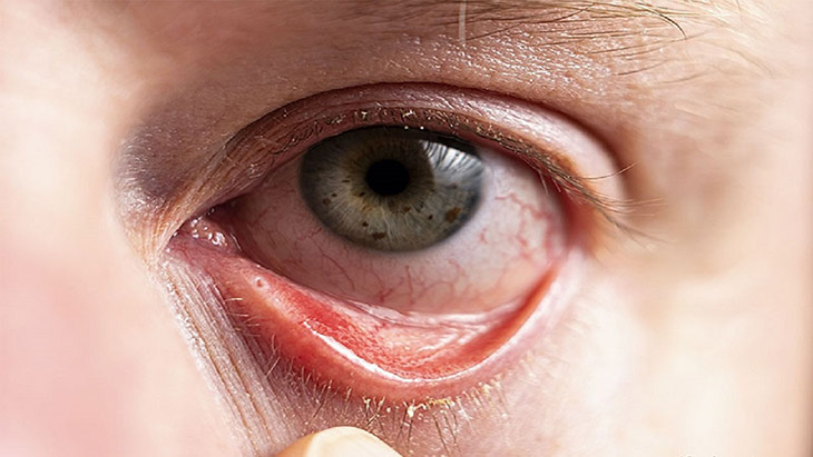 Viêm xoang có thể gây biến chứng ở mắt nên bạn cần hết sức lưu ý