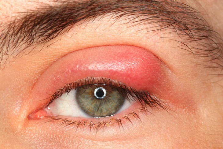 Người bệnh có thể gặp biến chứng áp xe mí mắt